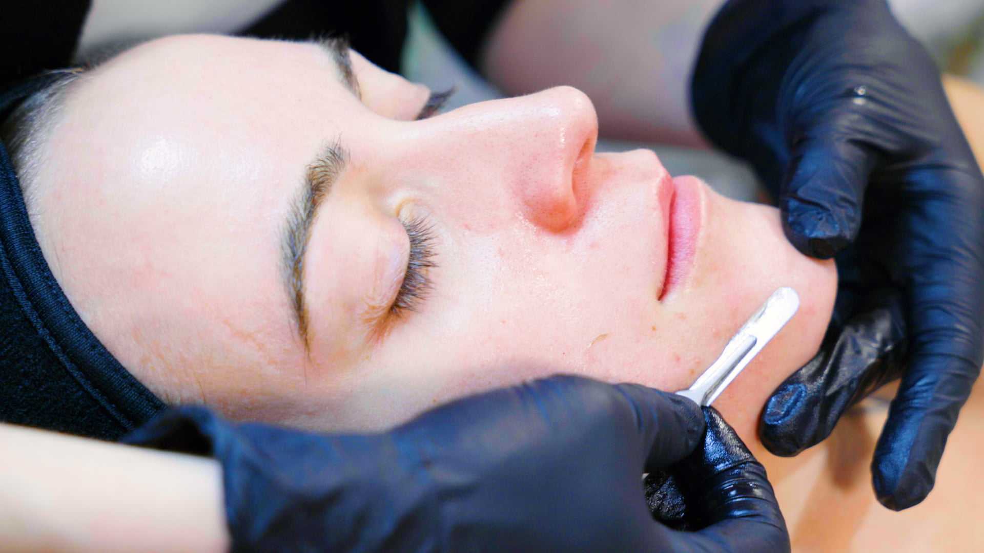 Dermaplaning treatment at BC Medical Aesthetic